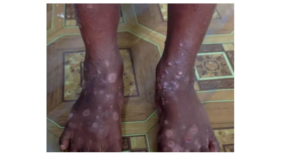 Health Prepares to Fight Scabies Through a Mass Drug Administration Campaign